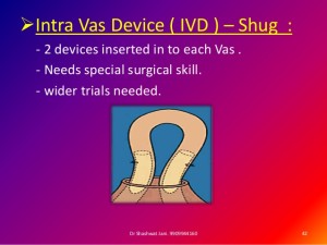 • Intra Vas Device (IVD)