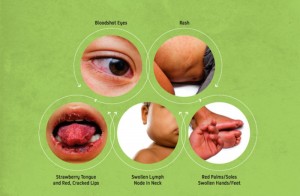 Symptoms of Zika virus infection 
