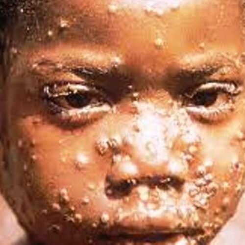 Akwa Ibom records fifth mpox case