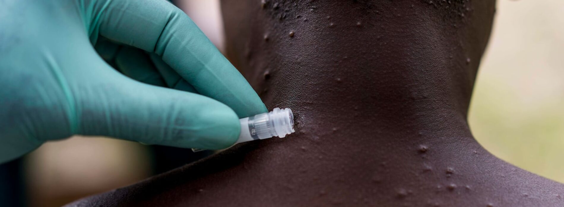 WHO, Africa CDC declares Mpox Public Health Emergency of International Concern