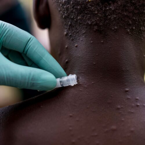 WHO, Africa CDC declares Mpox Public Health Emergency of International Concern